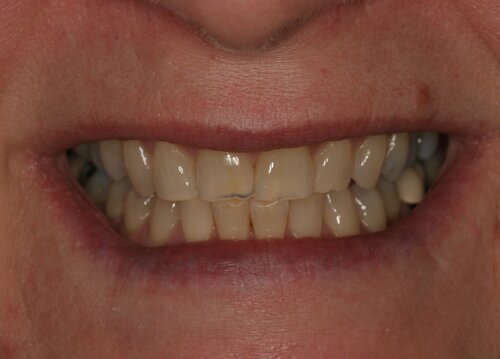 Patient before whitening