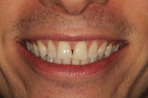 Patient before whitening