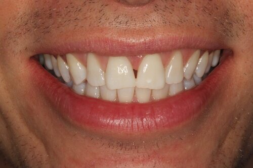 Patient after whitening