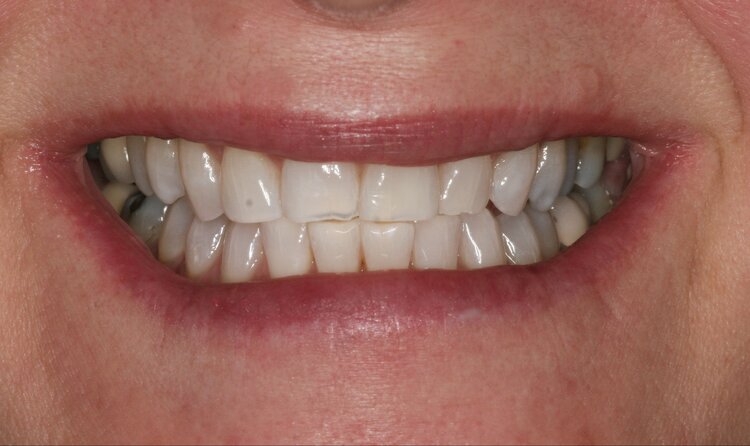 Patient after whitening