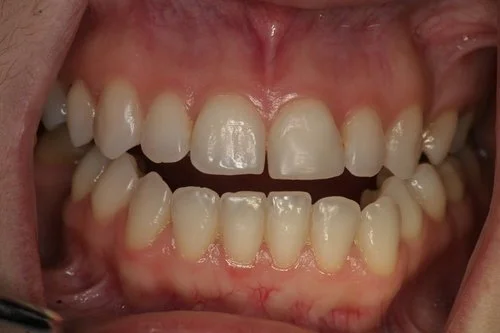 Patient before Invisalign