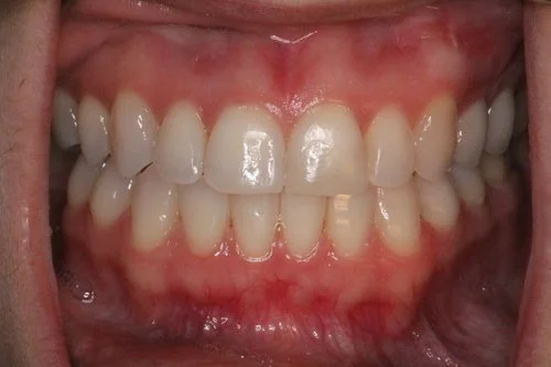Patient after Invisalign