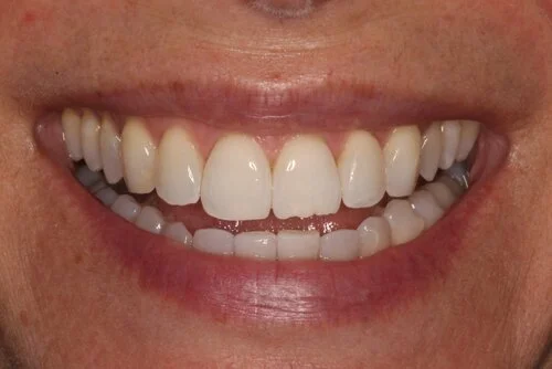 Patient before composite bonding