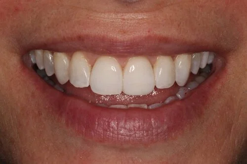 Patient after composite bonding