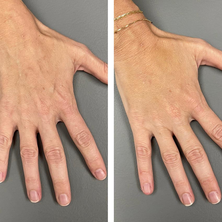Before and after Hyperdilute Radiesse® treatment showing rejuvenation on the hands