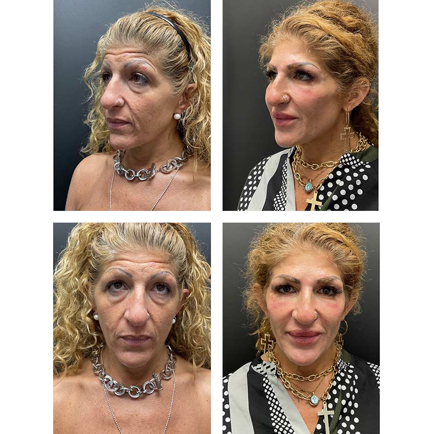 Before and after combination aesthetic treatment with Xeomin®, Radiesse®, and Versa® showing smoother skin, restored facial volume, and facial rejuvenation results