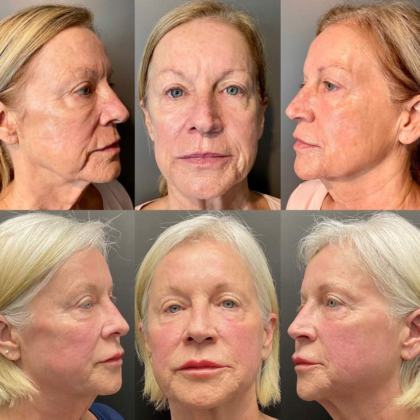 Before and after deep CO2 laser resurfacing and dermal filler treatment showing smoother skin texture, restored facial volume, and overall facial rejuvenation from multiple angles