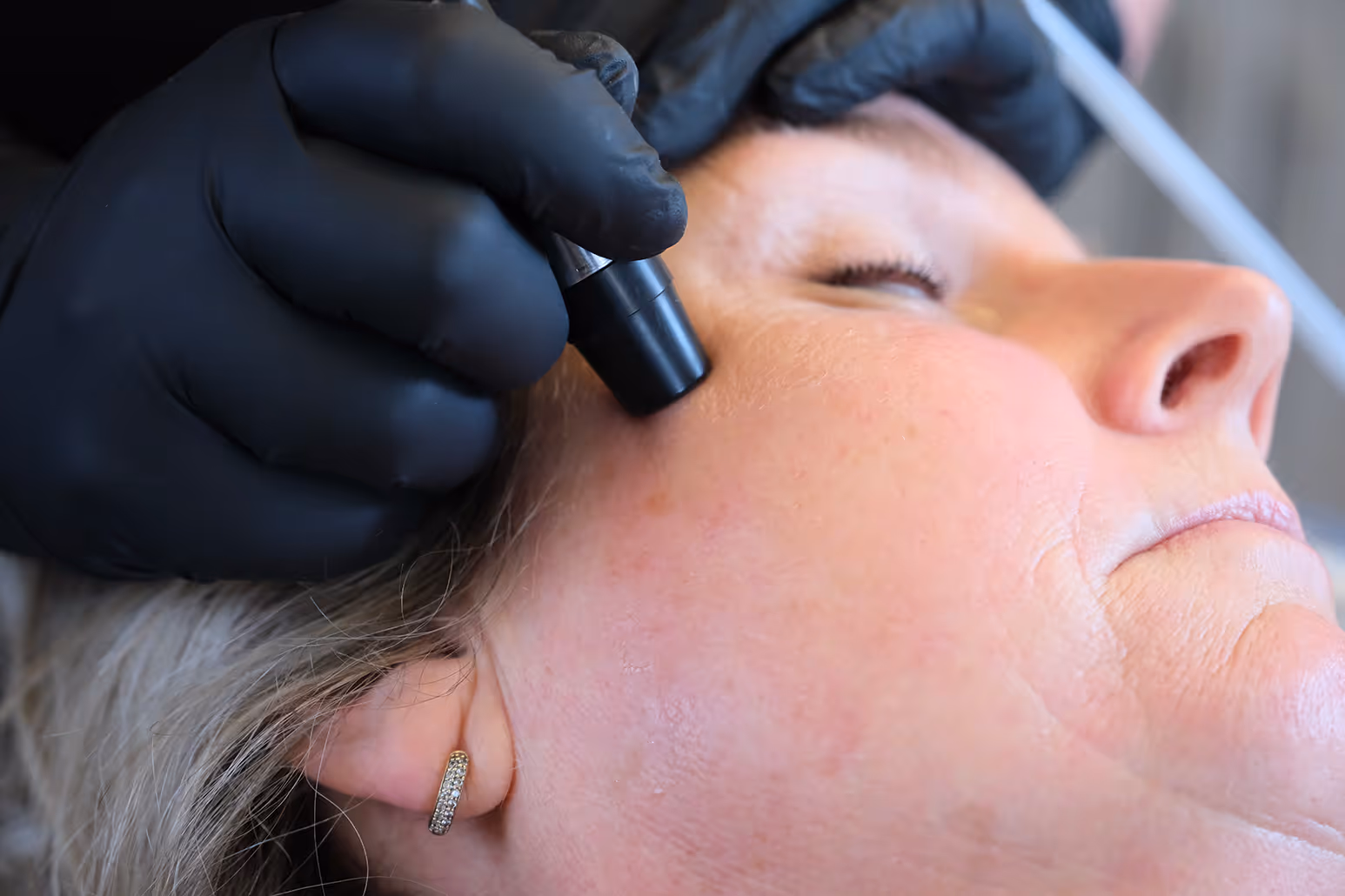 Microdermabrasie Behandeling