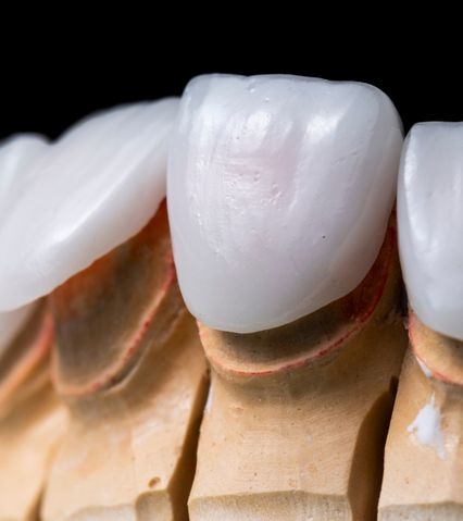 Detaliu macro al unei coroane dentare din material ceramic așezată pe o moldură dentară.