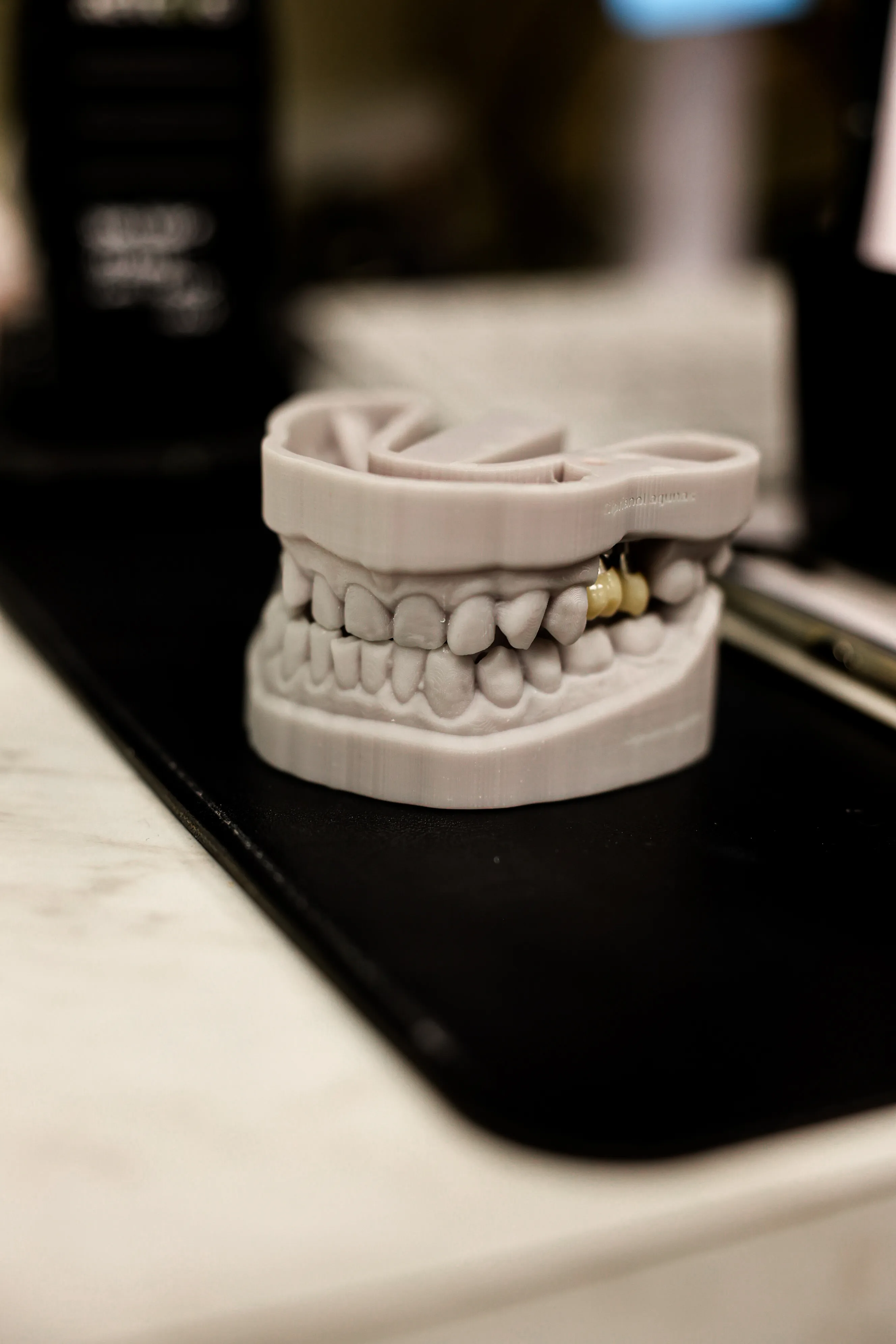 3D-printed dental model showing upper and lower teeth with a gold dental crown on a right molar.