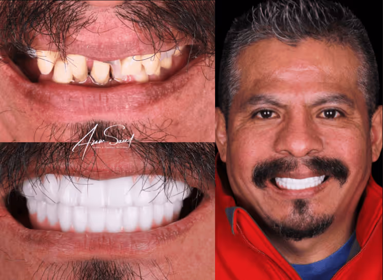 Before-and-after dental restoration photos showing a man's discolored and damaged teeth transformed into bright, even white teeth, alongside a smiling portrait of the man with the new smile.