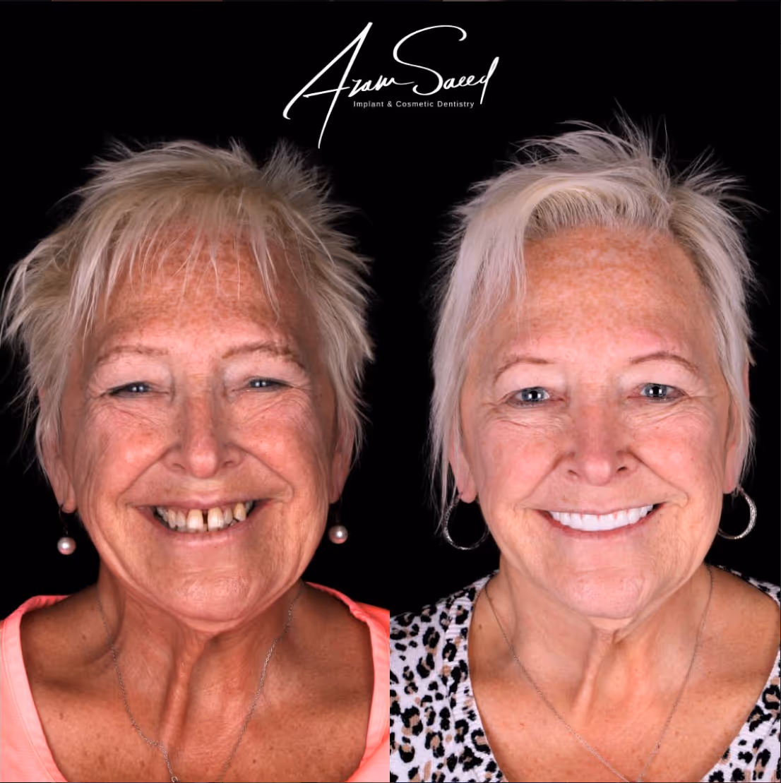 close up before and after results elderly woman