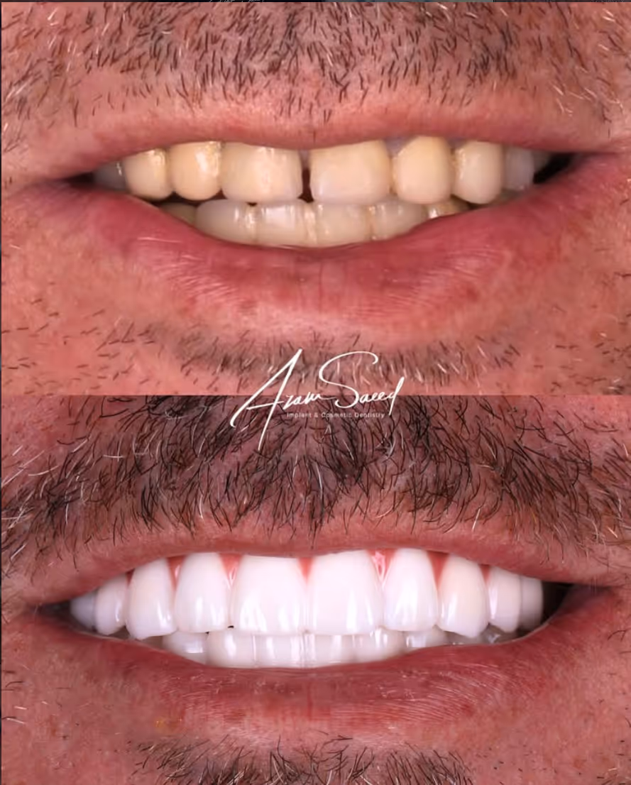 before and after results middle aged man 