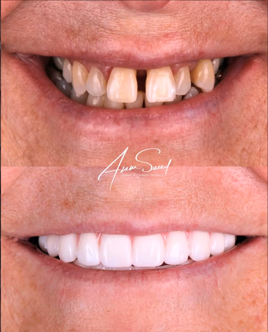 before and after results middle aged woman 