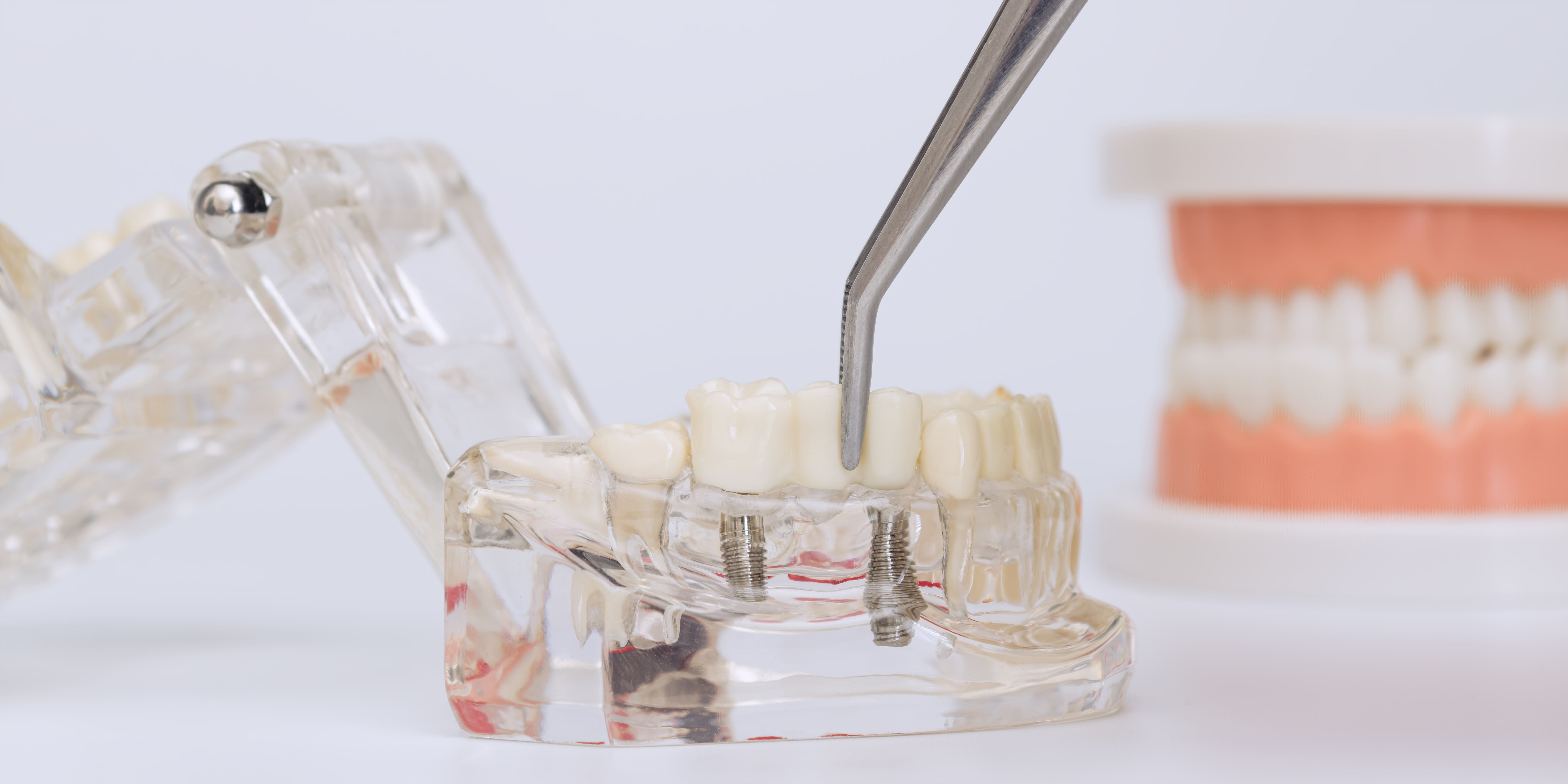 Implant bridge on a model 