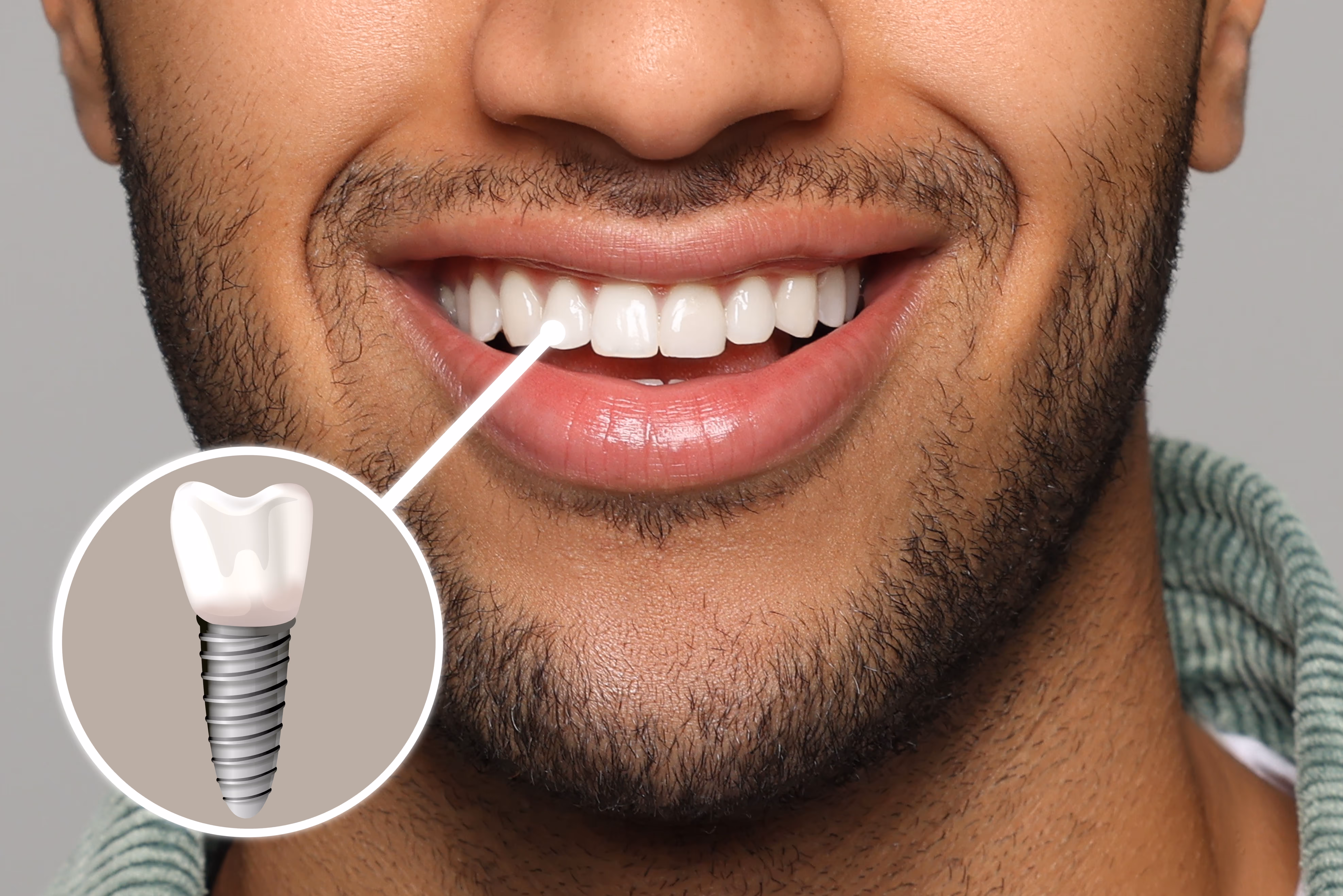 single tooth implant on male