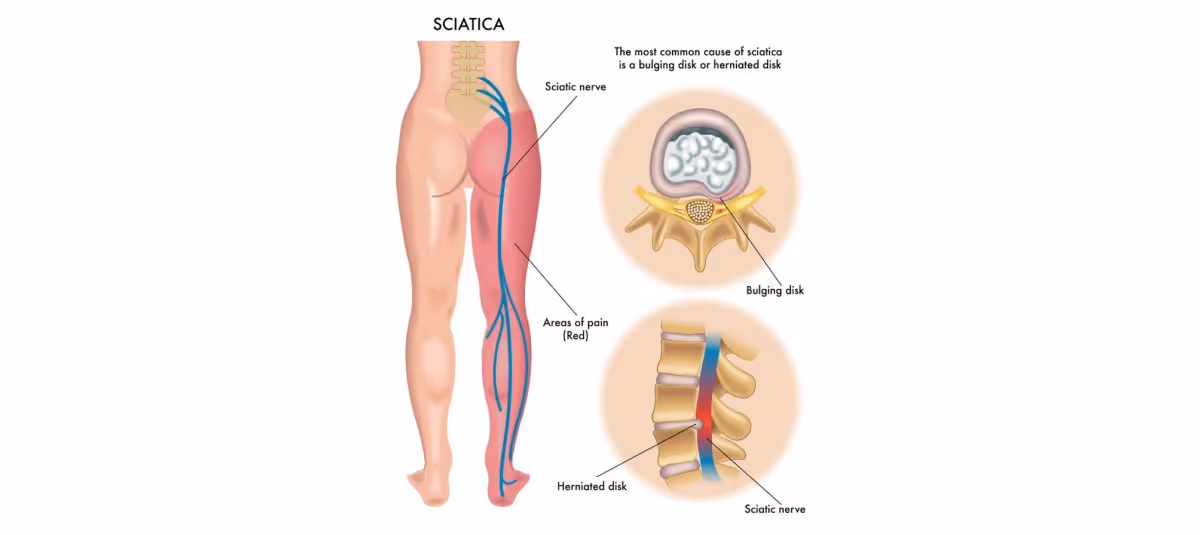 Chiropractic treatment for sciatica pain relief focused on spinal alignment and nerve pressure reduction