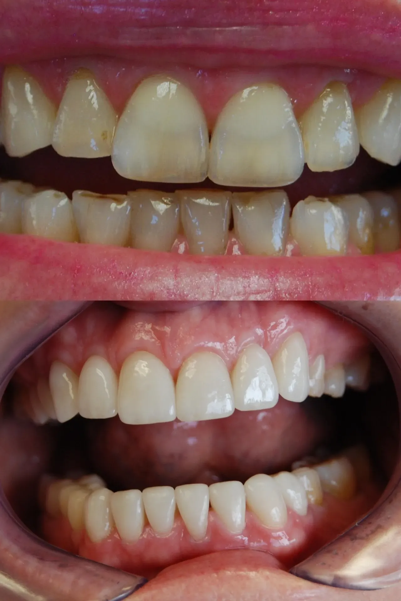 Illustrative before and after of a more even, whiter tooth shade