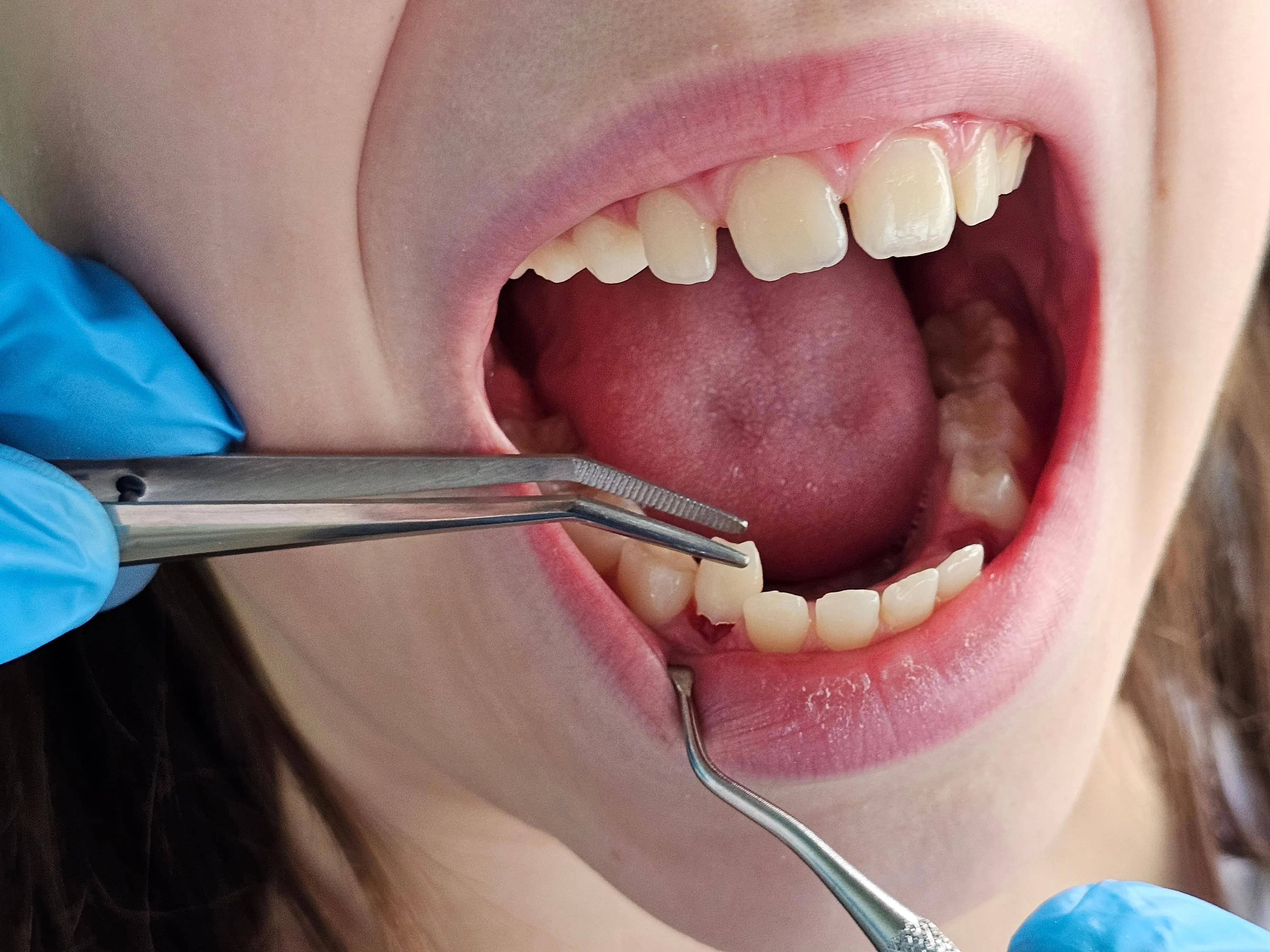 Dentist examining a patient's lower molars before treatment