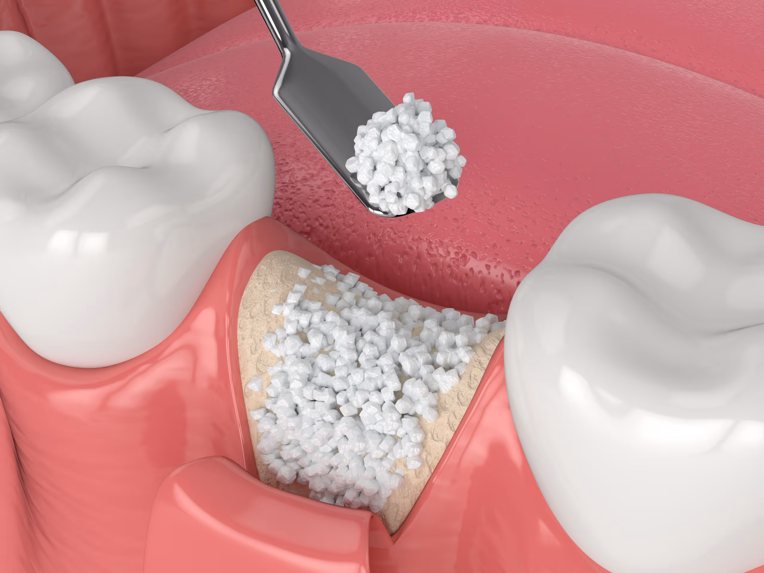 Illustration of dental bone grafting in the jaw