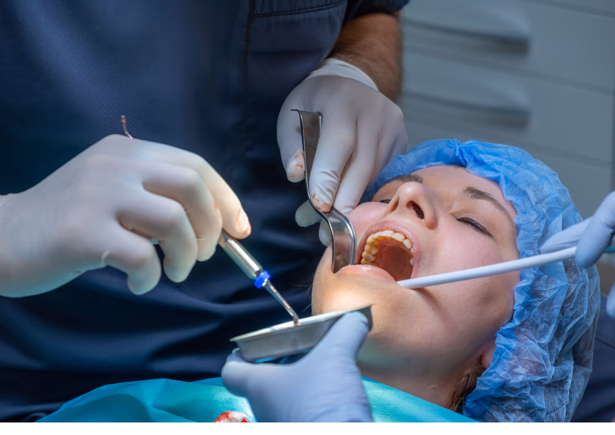 Dental bone grafting procedure for implant preparation