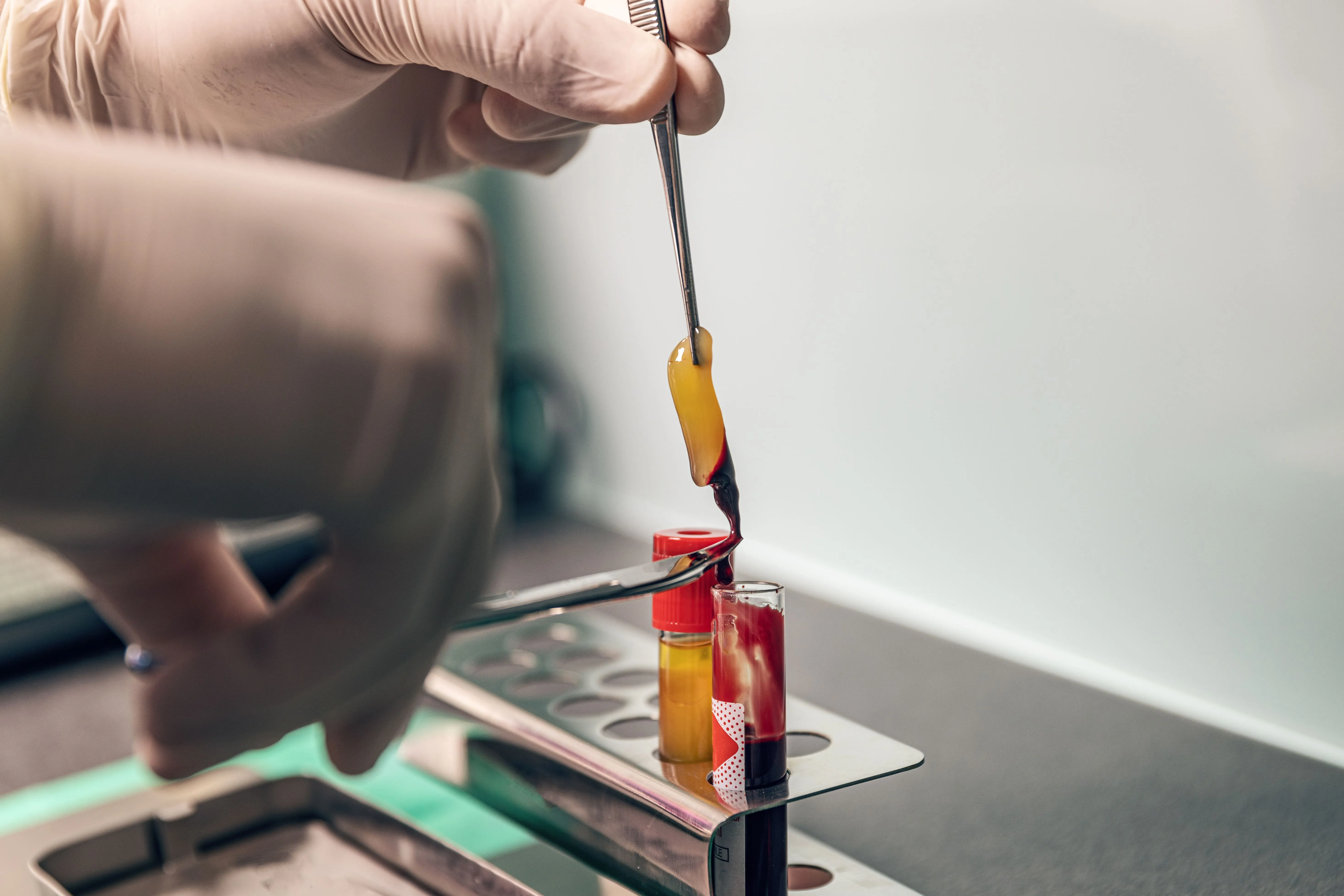 Clinician preparing platelet-rich fibrin from a blood sample