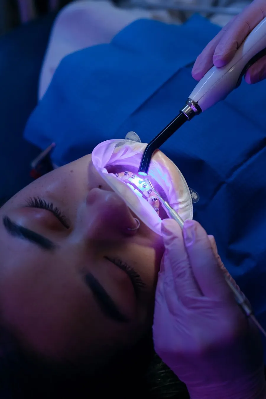 Patient receiving light-accelerated Philips Zoom in-office teeth whitening