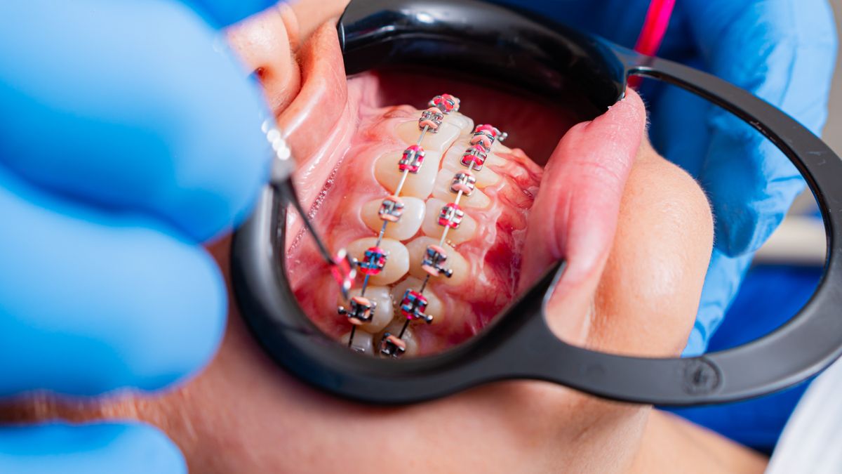 Close-up of orthodontic brackets used to guide an impacted canine into position
