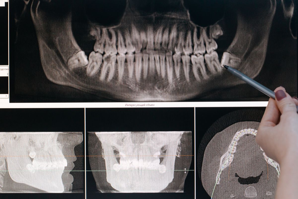 Panoramic dental X-ray used to diagnose a tooth fused to the jawbone