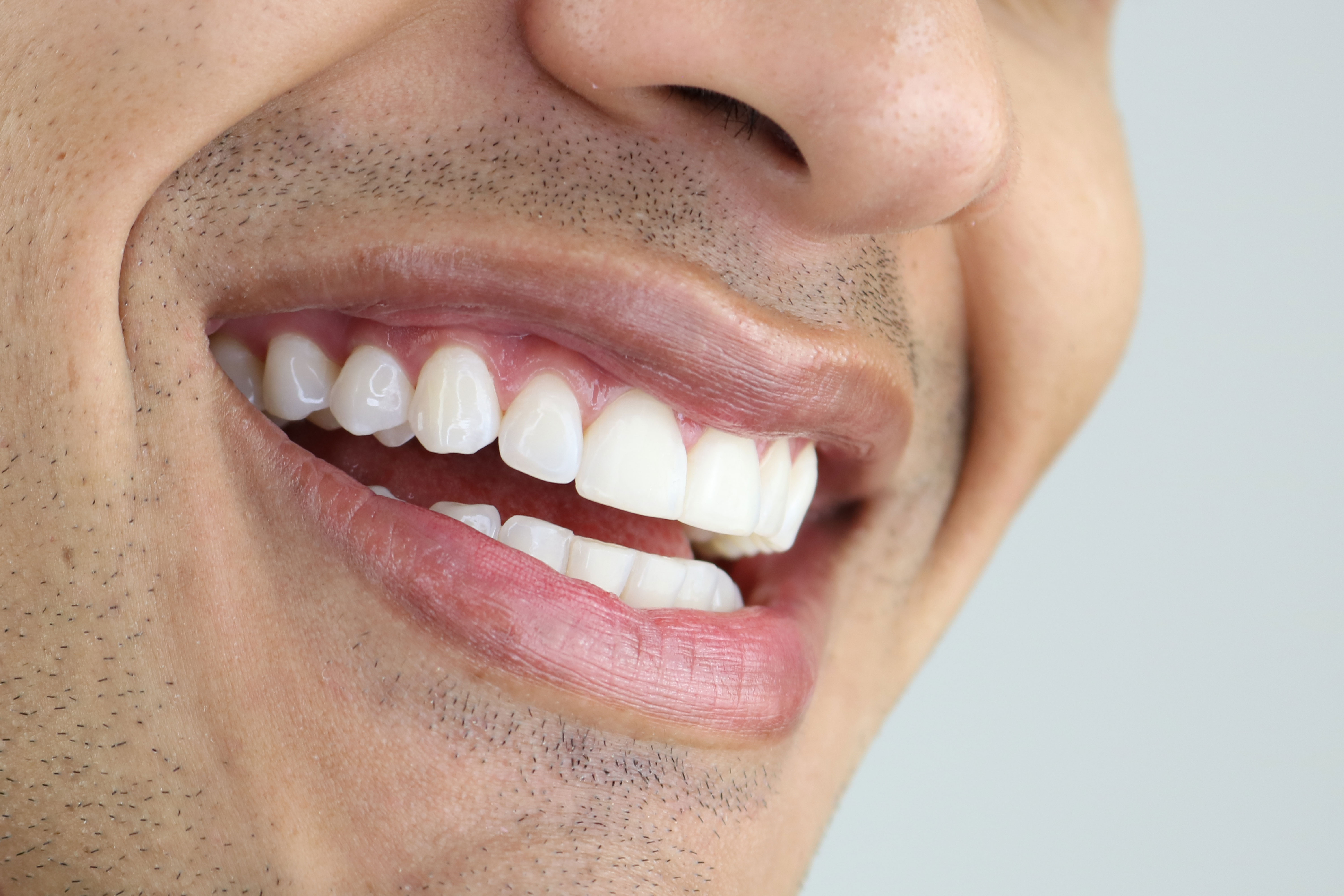Close-up of a man's bright, white smile after professional teeth whitening