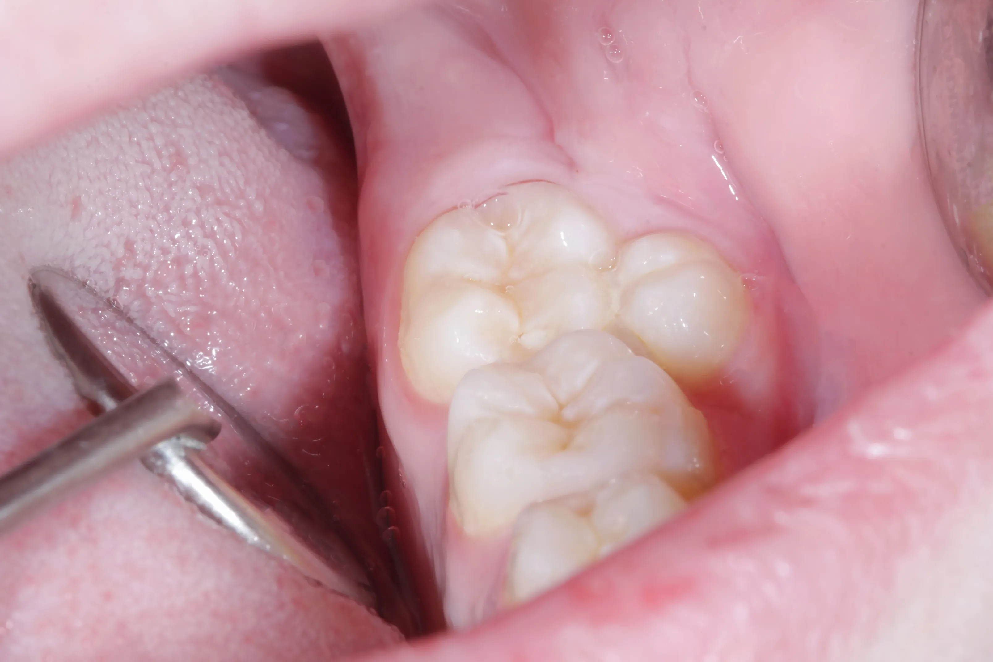Close up of lower molars with an extra erupting tooth crowding the back of the jaw