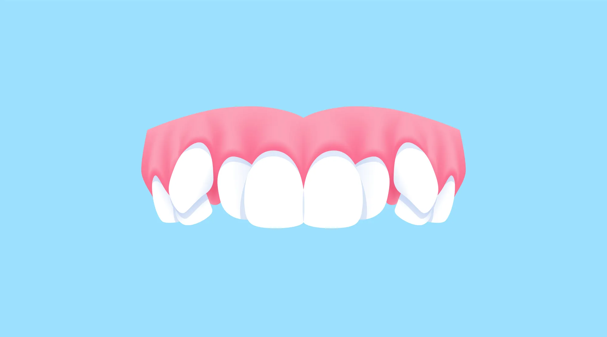 Illustration of upper canines sitting high in the gums instead of in line with the other teeth