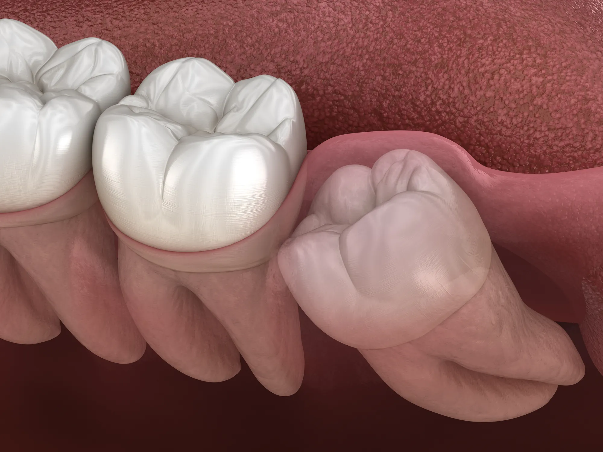 3D illustration of an impacted wisdom tooth growing at an angle into the molar beside it