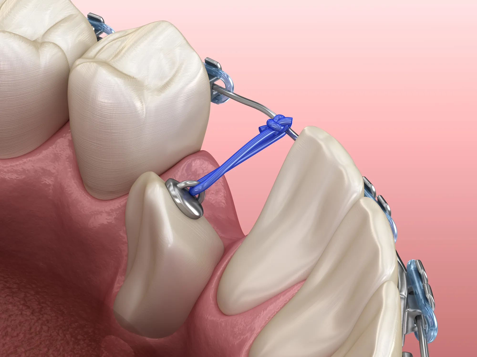 3D illustration of an impacted canine with a bonded bracket and chain guiding it into the arch