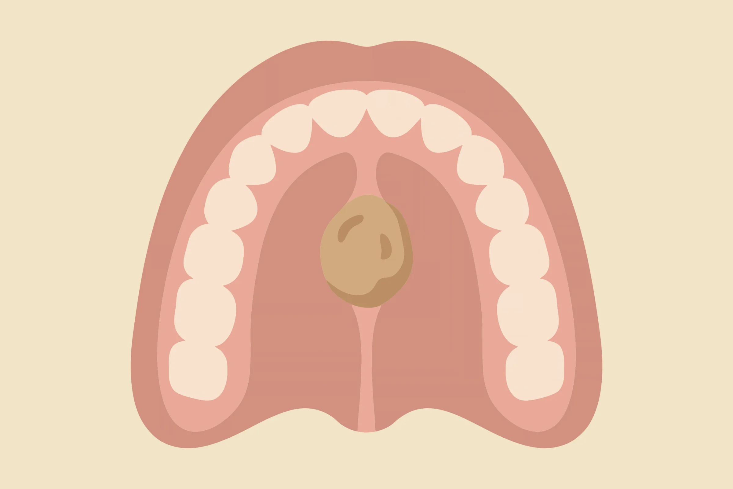 Illustration of a palatal torus, a bony growth in the middle of the roof of the mouth