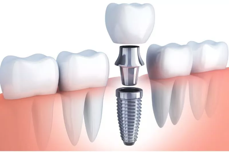 Dental implants are permanent tooth replacement solutions