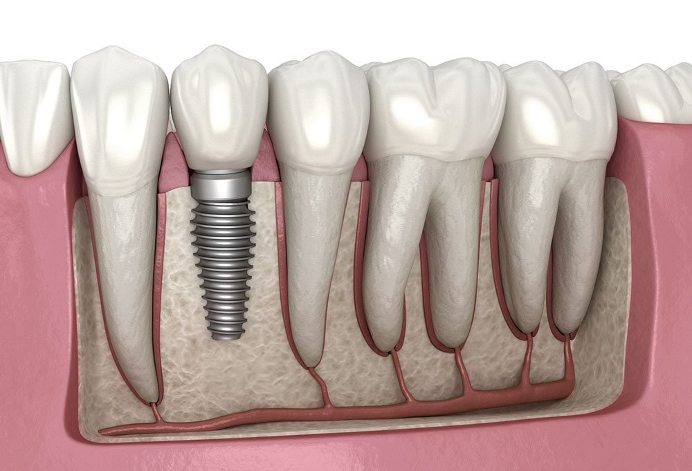 Dental implants can fix many dental problems