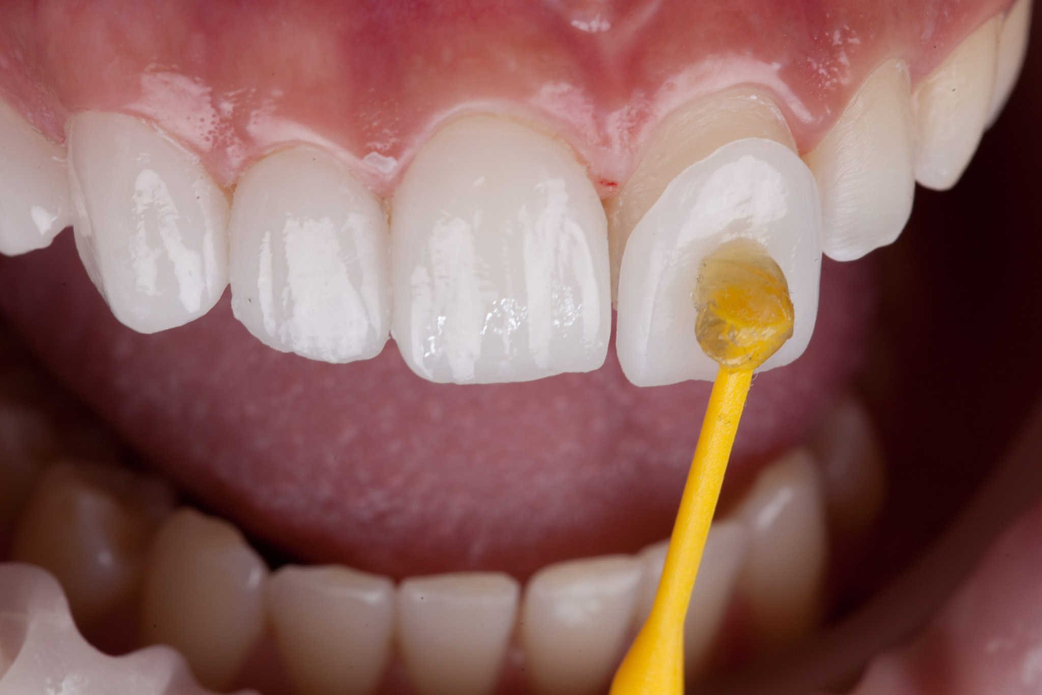 Most people find that veneers feel completely normal