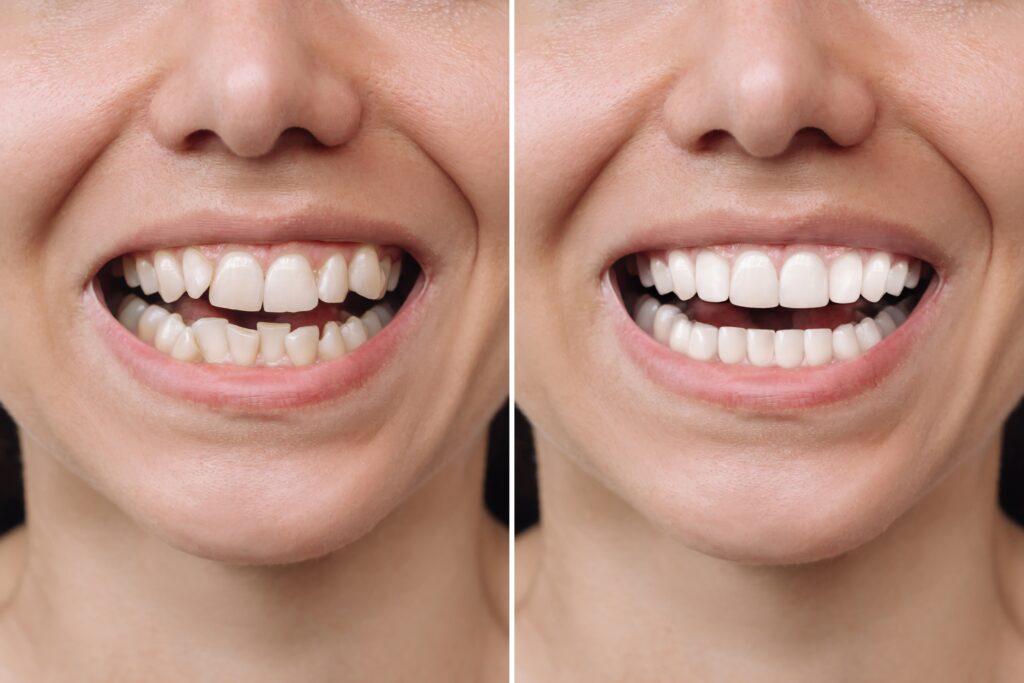 Dental veneers help give you a more confident smile