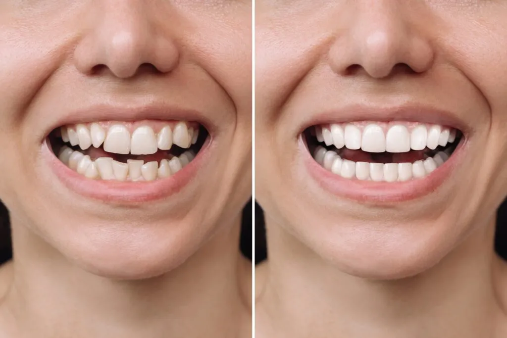 Dental veneers help give you a more confident smile