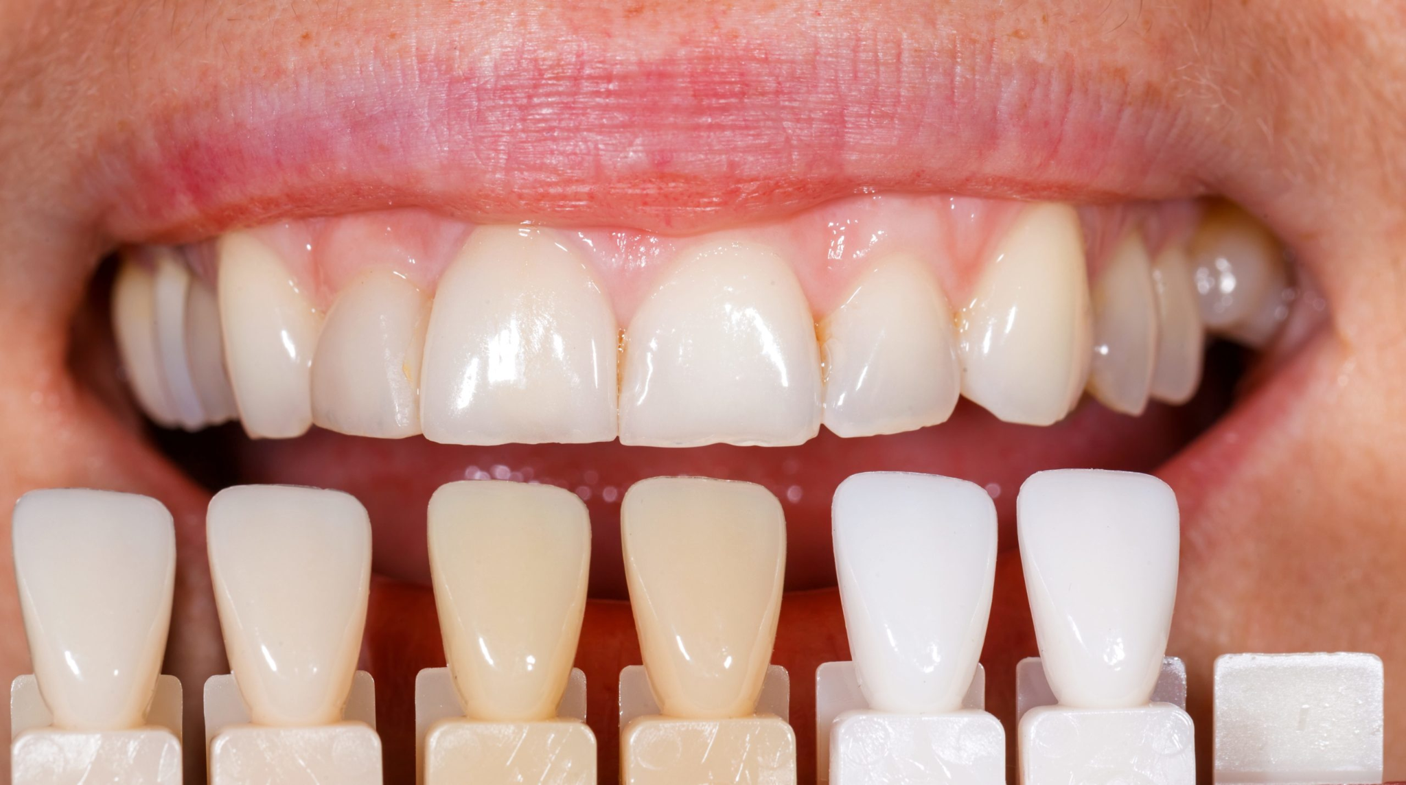 The best veneers’s candidates are individuals with healthy teeth and gums