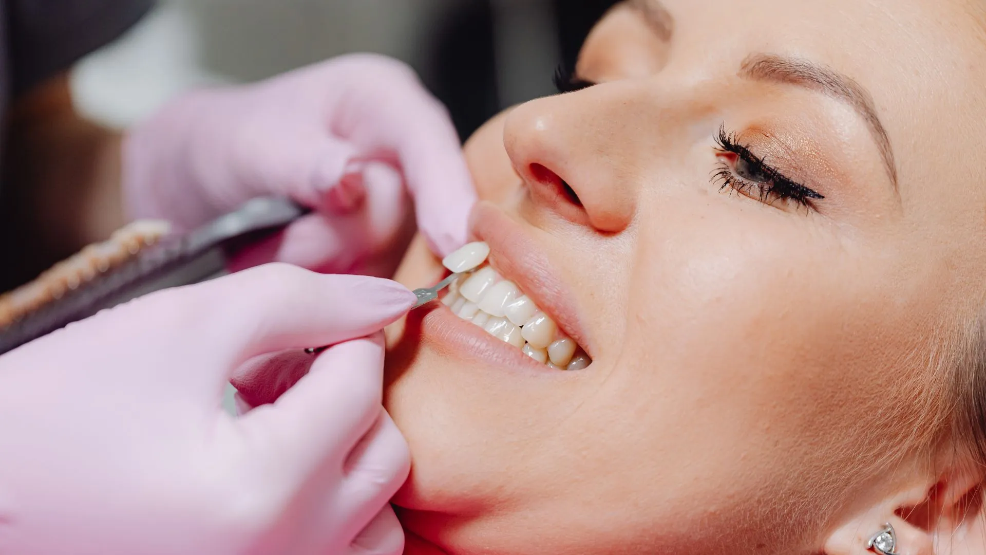 The Dental Veneer Process