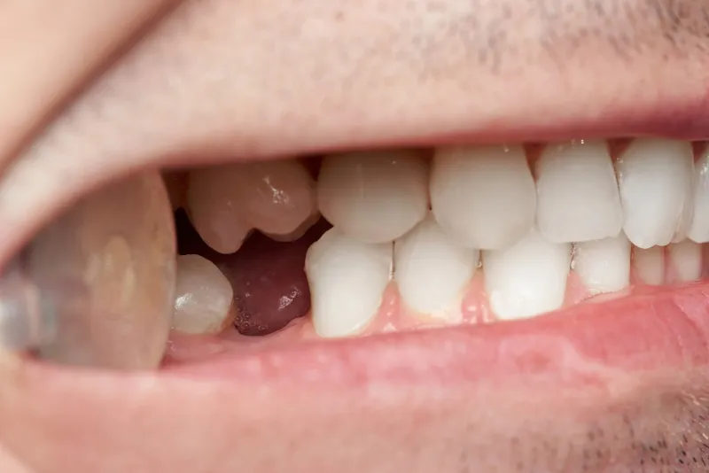 Bright white smile after professional teeth whitening at South Bay Dental Loft in Torrance, CA