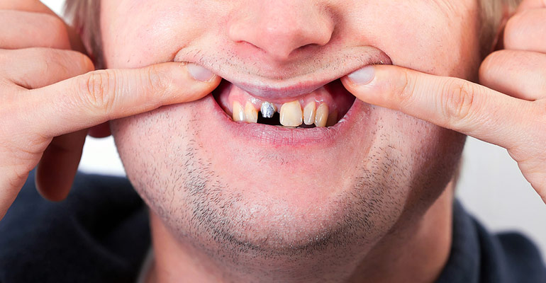 Is a Loose Dental Crown Considered a Dental Emergency?