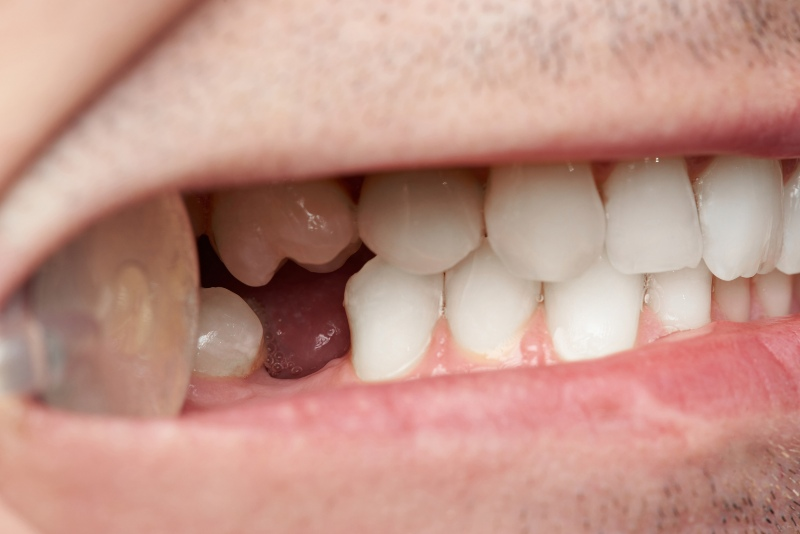 What Should You Do Immediately If Your Crown Comes Loose?