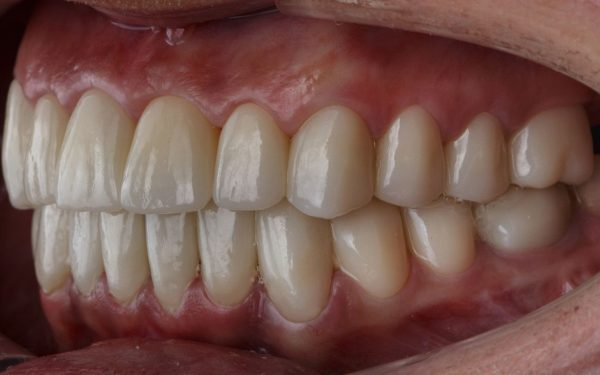 Dental Crown Come Loose