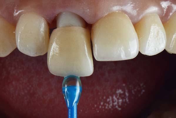 What Will Your Dentist Do to Fix a Loose Crown?