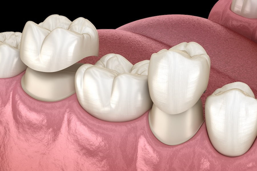 How to Prevent Your Dental Crown from Coming Loose Again