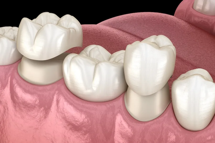 How to Prevent Your Dental Crown from Coming Loose Again