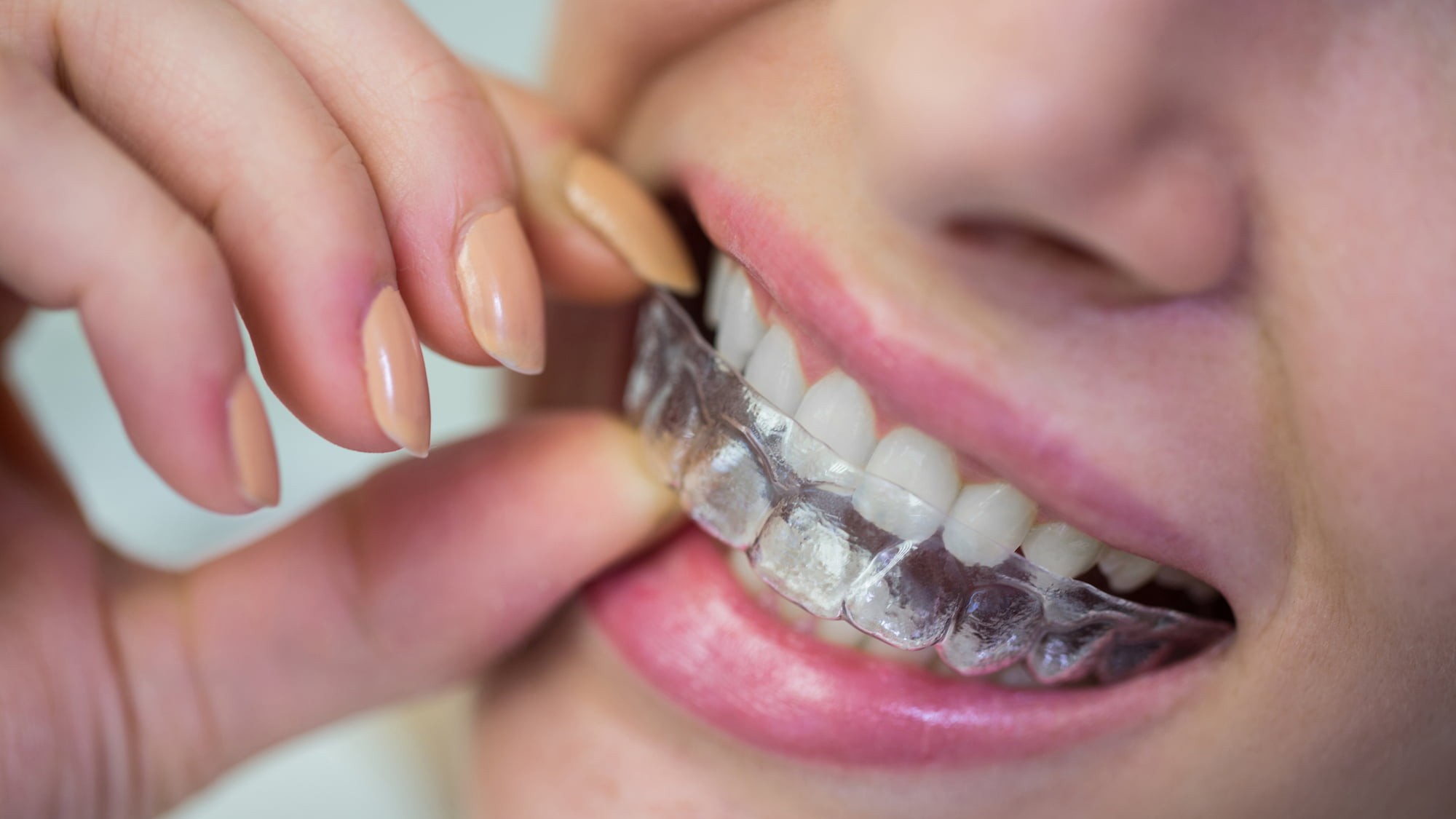 Close-up of a person inserting a clear orthodontic aligner onto their upper teeth.